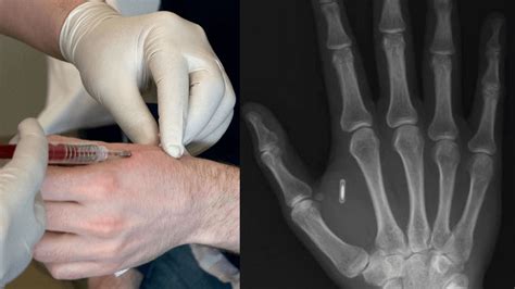 RFID & NFC human chip implants 